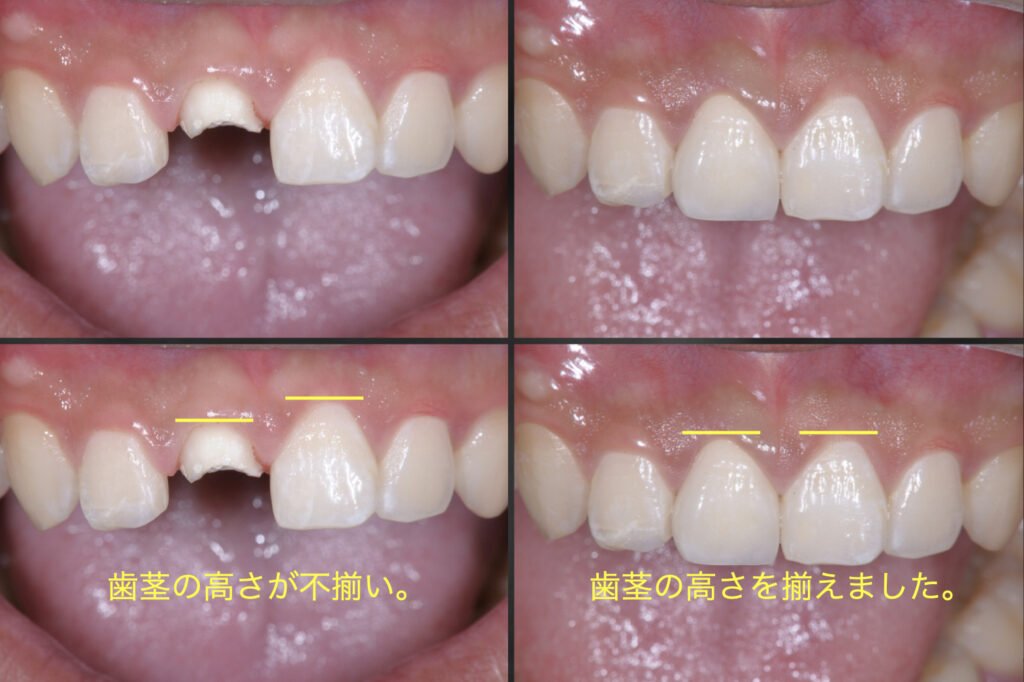 下関市おおむら歯科医院にてセラミック治療を行う前と後の比較を行なった画像。不揃いであった歯頸線（歯茎の高さ）も揃っており、天然歯との区別がつかない。